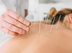 Acupuncture for sports injuries growing in popular